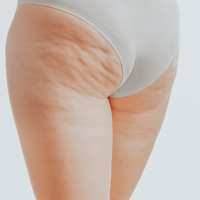 butts of a women with un natural skin