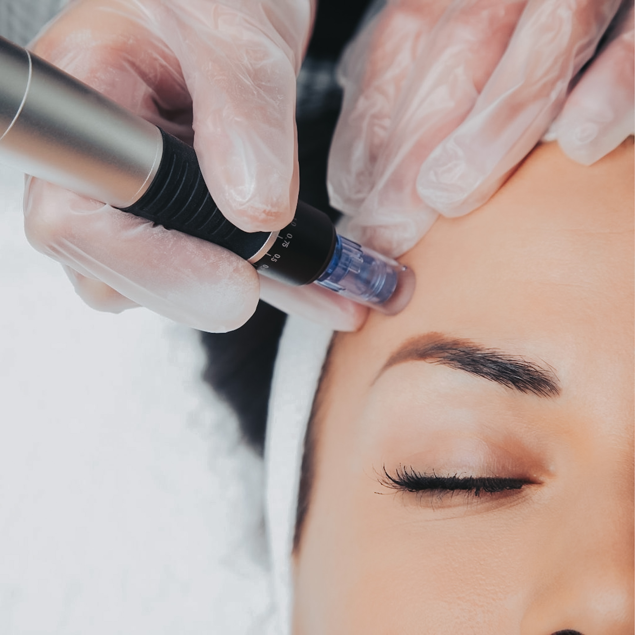 What Is Exceed Microneedling? A Beginner’s Guide