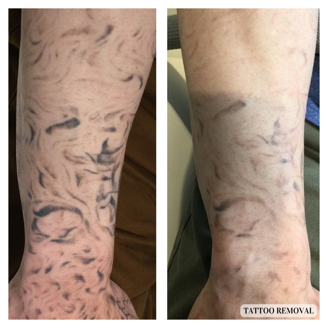 MEDICAL SPA IN RALEIGH NC Tattoo removal
