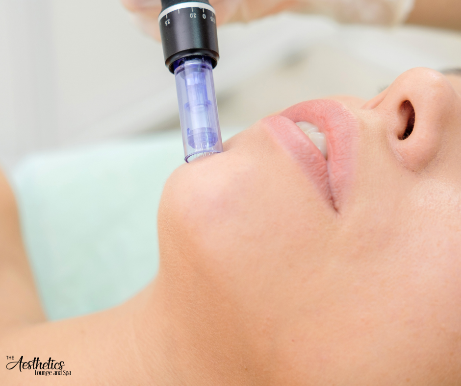 Experience Skin Transformation with Profound Microneedling at The Aesthetics Lounge and Spa Raleigh!
