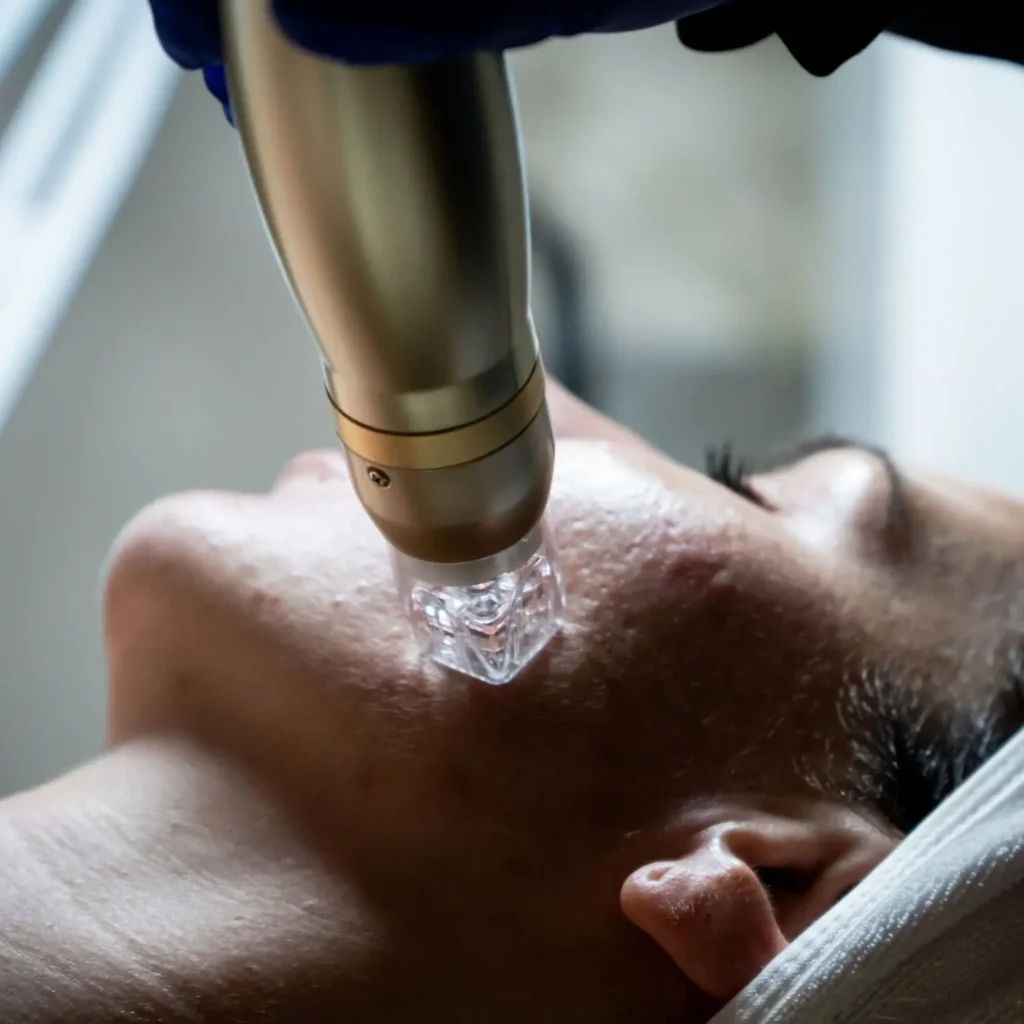 Sylfirm X RF Microneedling